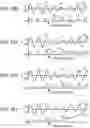 Fig. 84 - Methods, systems and devices for non-invasive open ventilation with gas delivery nozzles within nasal pillows