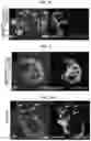 Fig. 17 - ENDONUCLEASE SEXING AND STERILIZATION IN INSECTS