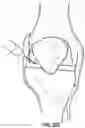 Fig. 37 - Devices, systems and methods for tissue analysis, location determination and therapy thereof using optical radiation