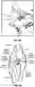 Fig. 46 - Devices, systems and methods for tissue analysis, location determination and therapy thereof using optical radiation