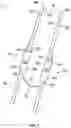 Fig. 11 - SURGICAL INSTRUMENT SLEEVE SYSTEM