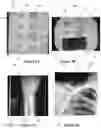 Fig. 05 - Anatomical side x-ray markers comprising non-metallic material