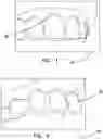 Fig. 03 - Method of self determining the degree of fit of an orthodontic aligner by a patient with the patient's teeth