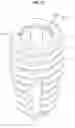 Fig. 13 - FIXTURE OF DENTAL IMPLANT