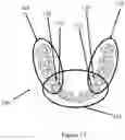 Fig. 10 - Digitizing and merging sectional impression trays to create a dental arch for dental device manufacturing