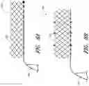 Fig. 09 - Percutaneous method and device to treat dissections