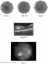Fig. 02 - Novel Method of Treating Macular Degeneration Using Botulinum Toxin-Based Pharmaceuticals
