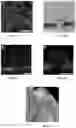 Fig. 04 - Novel Method of Treating Macular Degeneration Using Botulinum Toxin-Based Pharmaceuticals