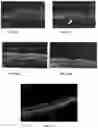 Fig. 07 - Novel Method of Treating Macular Degeneration Using Botulinum Toxin-Based Pharmaceuticals