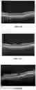 Fig. 08 - Novel Method of Treating Macular Degeneration Using Botulinum Toxin-Based Pharmaceuticals