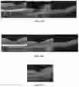 Fig. 09 - Novel Method of Treating Macular Degeneration Using Botulinum Toxin-Based Pharmaceuticals