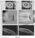 Fig. 14 - Novel Method of Treating Macular Degeneration Using Botulinum Toxin-Based Pharmaceuticals