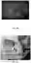 Fig. 16 - Novel Method of Treating Macular Degeneration Using Botulinum Toxin-Based Pharmaceuticals