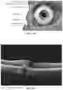 Fig. 17 - Novel Method of Treating Macular Degeneration Using Botulinum Toxin-Based Pharmaceuticals