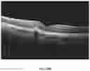 Fig. 18 - Novel Method of Treating Macular Degeneration Using Botulinum Toxin-Based Pharmaceuticals