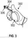 Fig. 03 - Applicator Glove