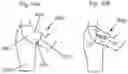 Fig. 15 - FASHION SCRUNCH CLIP APPARATUS AND METHOD
