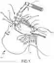 Fig. 02 - Retractor and tip extender therefor