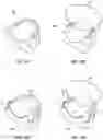 Fig. 07 - Method of manufacturing mouth guard having internal components for sensing impact forces
