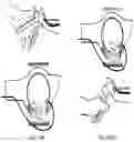 Fig. 16 - Articulating patient positioning apparatus