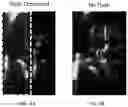 Fig. 04 - Kalman filtering for flash artifact suppression in ultrasound imaging