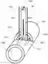 Fig. 01 - Medical apparatus and method for closing an opening in a tissue