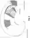 Fig. 04 - Meniscus repair