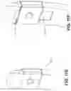 Fig. 18 - Meniscus repair