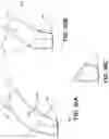 Fig. 44 - Meniscus repair