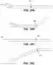 Fig. 47 - Meniscus repair