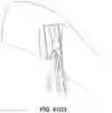 Fig. 60 - Meniscus repair