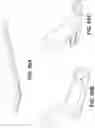 Fig. 79 - Meniscus repair