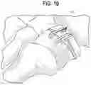 Fig. 07 - Orthopedic implant, method, and kit