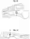 Fig. 09 - Orthopedic implant, method, and kit