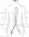 Fig. 02 - Devices and method for blood vessel occlusion