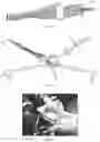 Fig. 05 - A COLLAPSIBLE AND ADJUSTABLE VESSEL TREATMENT DEVICE AND ADVANCED CUFF WITH INDEPENDENT AND DYNAMICALLY CONTROLLED CHARGE AND DISCHARGE MODES FOR A VESSEL OR SAC WALL TREATMENT AND A CARDIAC ASSIST DEVICE