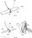 Fig. 16 - A COLLAPSIBLE AND ADJUSTABLE VESSEL TREATMENT DEVICE AND ADVANCED CUFF WITH INDEPENDENT AND DYNAMICALLY CONTROLLED CHARGE AND DISCHARGE MODES FOR A VESSEL OR SAC WALL TREATMENT AND A CARDIAC ASSIST DEVICE