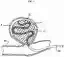Fig. 02 - Aneurysm method and system