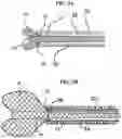Fig. 06 - Aneurysm method and system