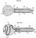 Fig. 07 - Aneurysm method and system