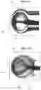 Fig. 17 - Aneurysm method and system
