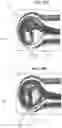 Fig. 19 - Aneurysm method and system