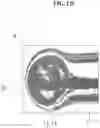 Fig. 20 - Aneurysm method and system