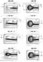 Fig. 09 - ANEURYSM DEVICE AND DELIVERY SYSTEM