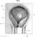 Fig. 10 - ANEURYSM DEVICE AND DELIVERY SYSTEM