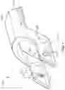 Fig. 09 - Surgical instrument with removable portion to facilitate cleaning
