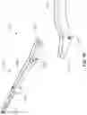 Fig. 12 - Surgical instrument with removable portion to facilitate cleaning