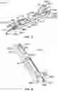Fig. 40 - Surgical instrument with removable portion to facilitate cleaning