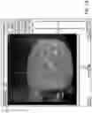 Fig. 46 - Automated image-guided tissue resection and treatment