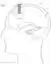 Fig. 02 - Expandable and collapsible brain cannula